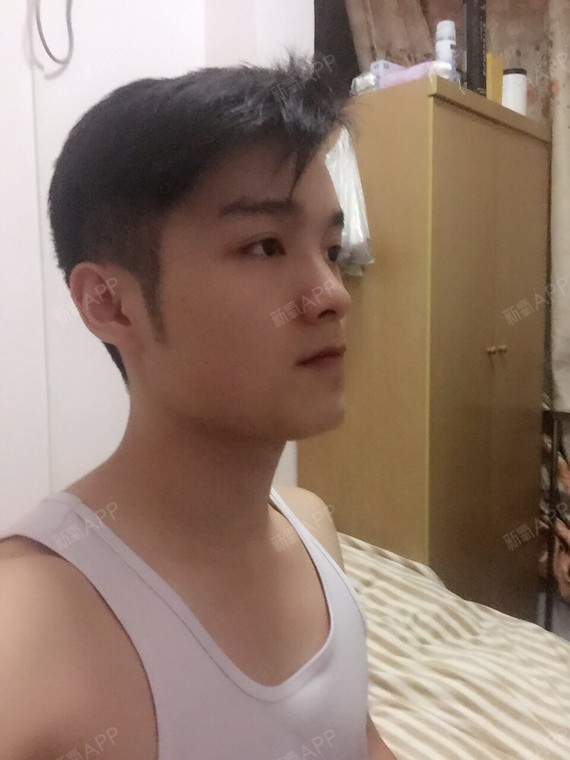 永远_550192种植发际线第337天美丽日记-新氧