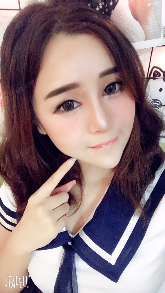 泰民爱水晶开内眼角第174天美丽日记-新氧美容