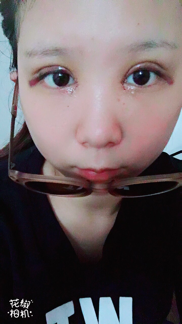 开内眼角第2天