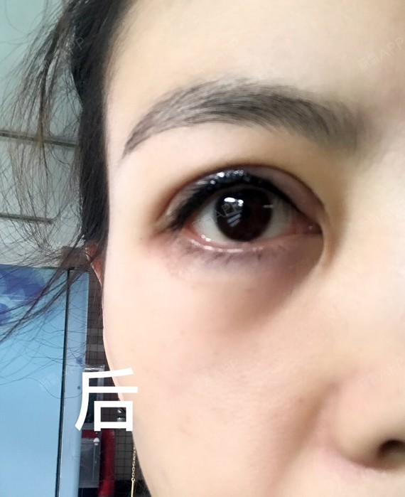 上海半永久美瞳线好不好_效果图_百陆半永久美瞳线术