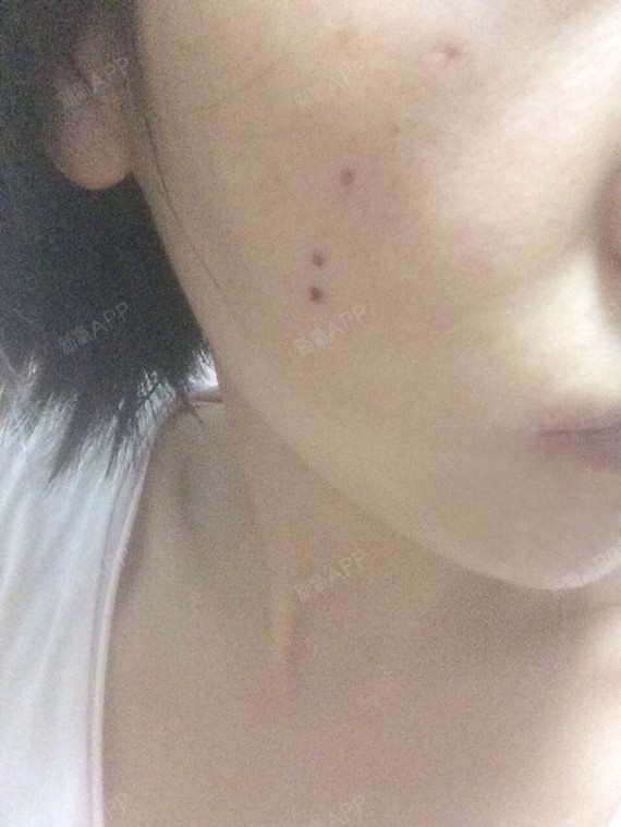 激光点痣