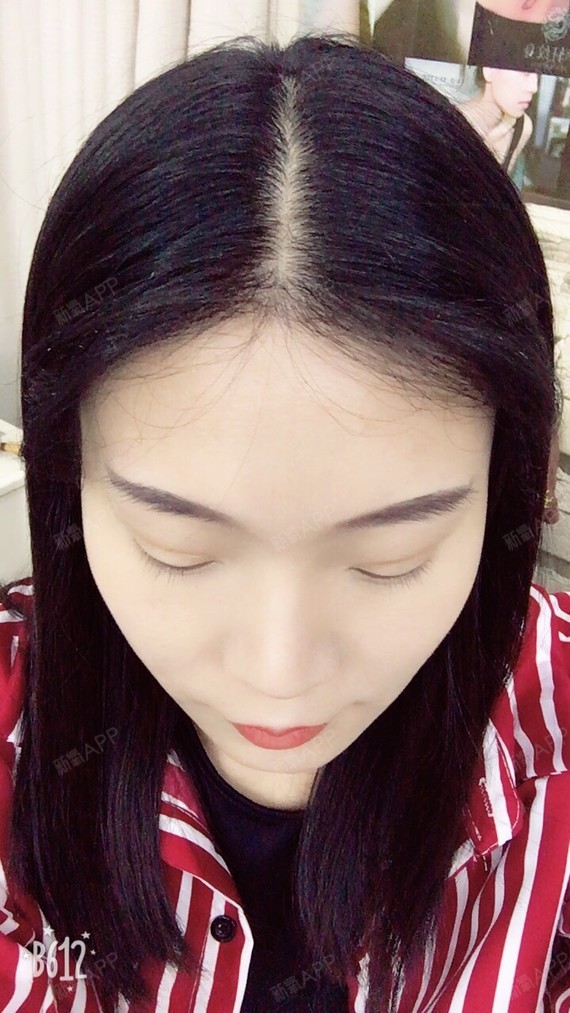 保持安静种植发际线第280天美丽日记-新氧美容