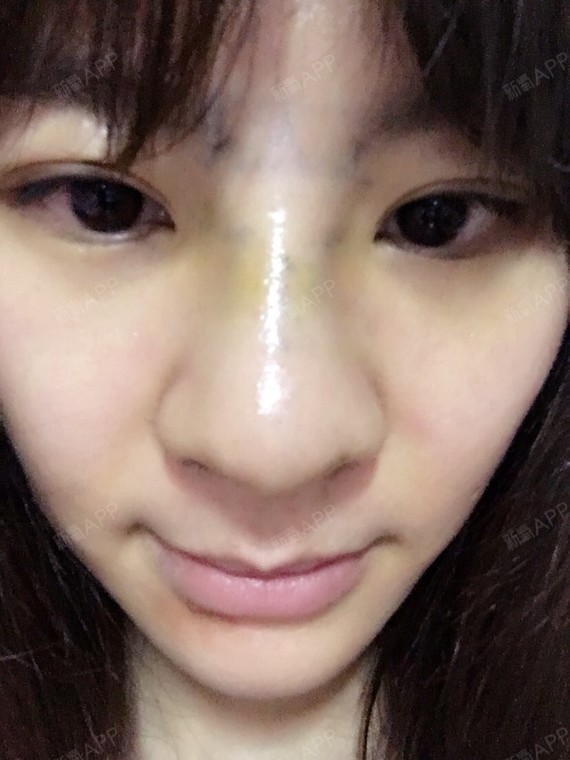隆鼻后第6天 鼻翼好大好肿 后期会消