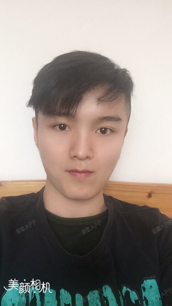 永远_550192种植发际线第349天美丽日记-新氧