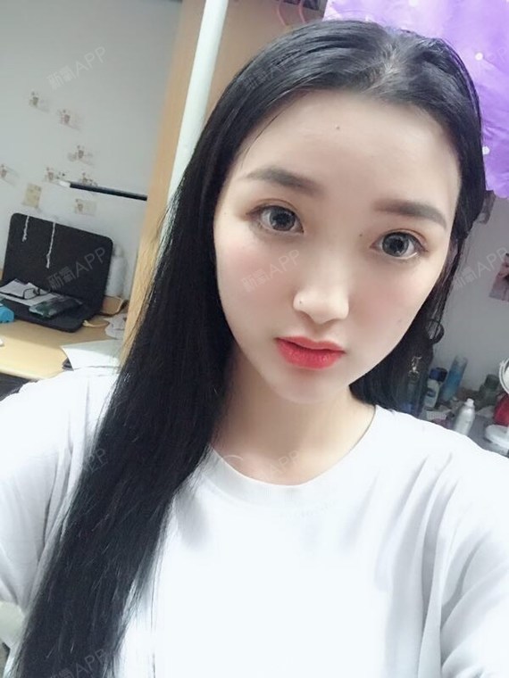做完自体脂肪面部填充手术后