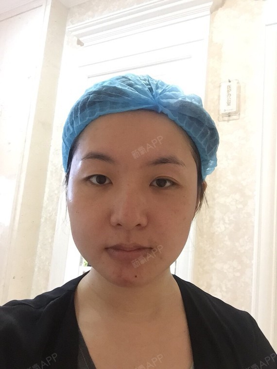 广西壮族自治区柳州开内眼角好不好_效果图_桐桐花雨0