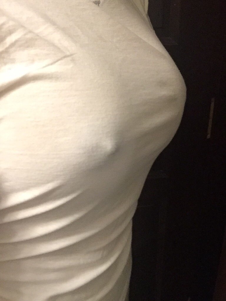 自体脂肪隆胸