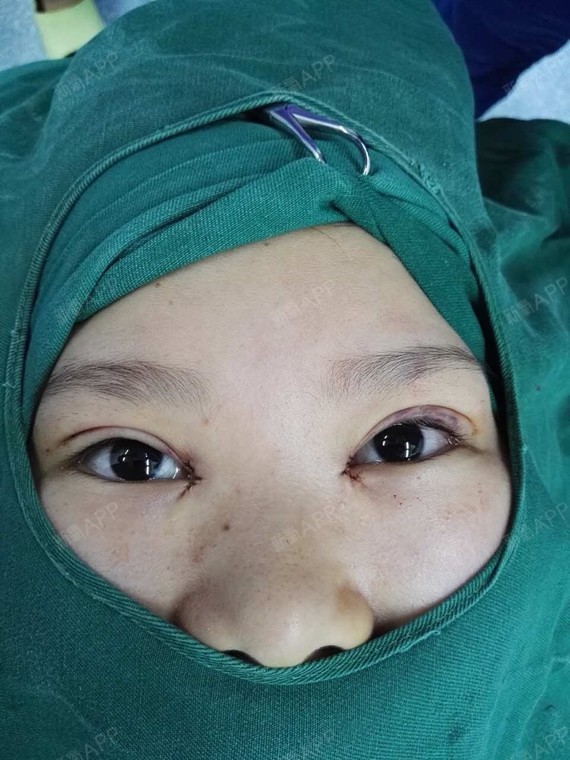 凌怀君开内眼角术后第天美丽日记_新氧整形