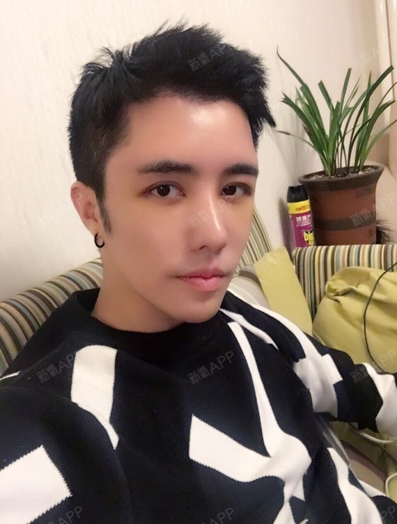 刘泽雨额头缩小第303天美丽日记-新氧美容整形