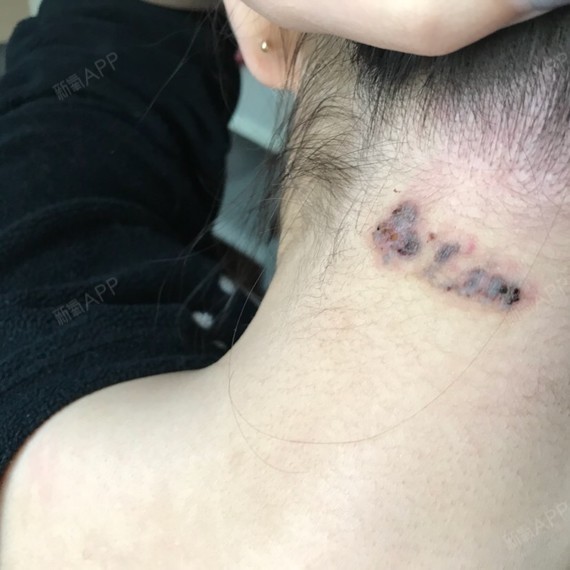 脖子后面的已经开始结痂了能看到明显颜色变浅了很多锁_圈子-新氧美容