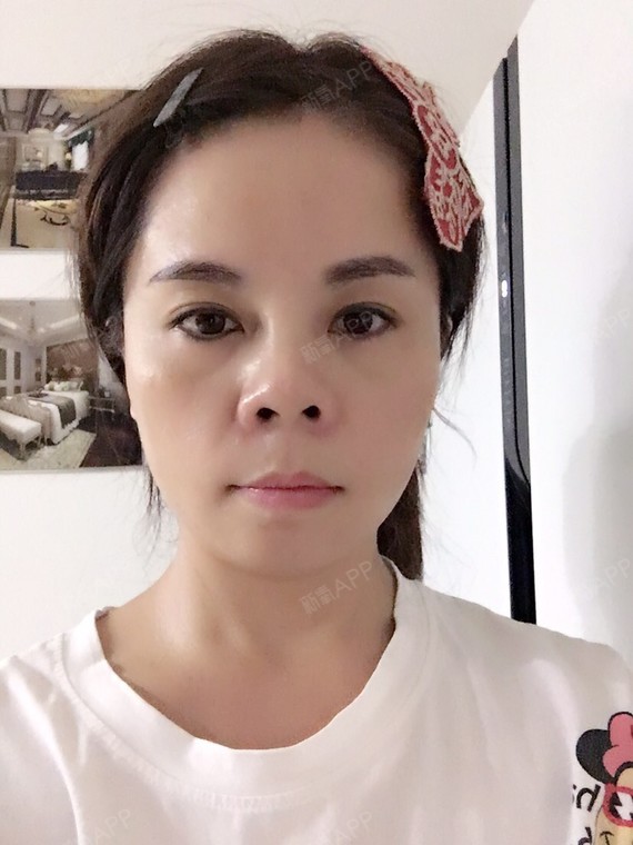 长沙手术缩鼻头好不好_效果图_氧气x4w0a36手术缩鼻头