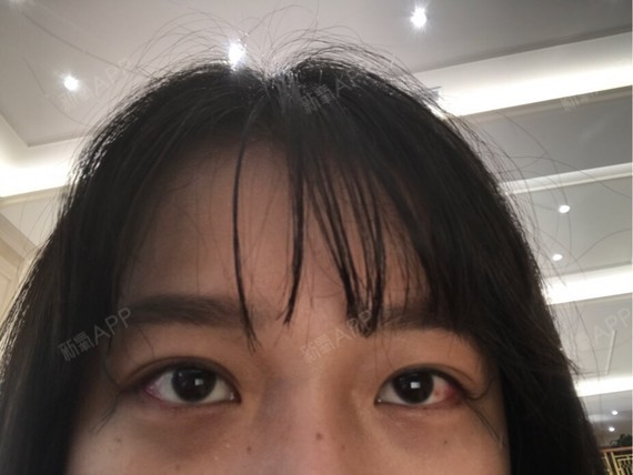新氧- 氧气0485481498752268 | 眼部 | 开眼角 | 开外眼角 | 术后当