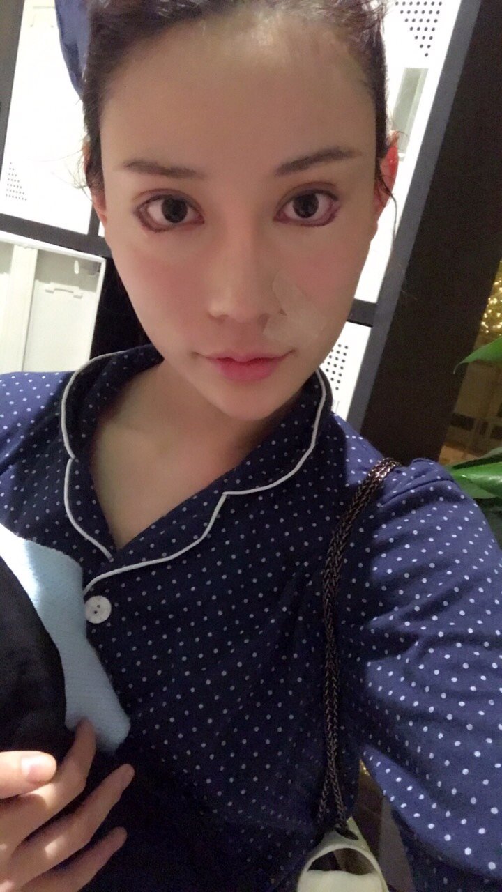 下眼下至术第1天