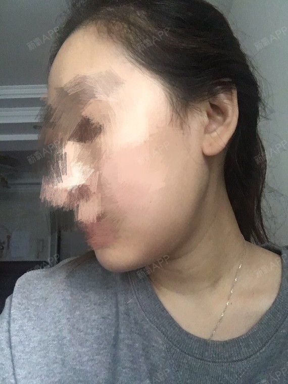 新氧 大迷糊小惠子 面部轮廓 颧骨颧弓 v型脸 术后当自强