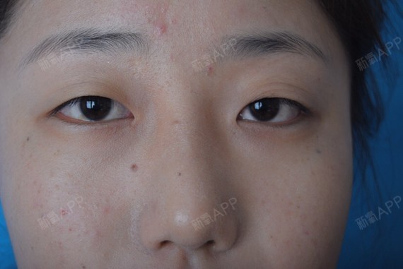 术前;单眼皮,左右上睑的皮肤组织松弛程度不一,眼睛小,眼无神.