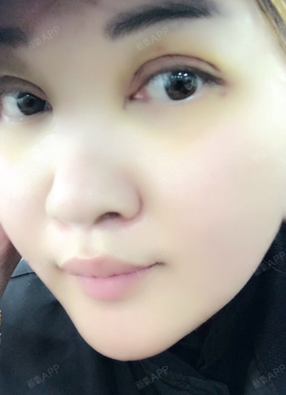 全切双眼皮术后第5天