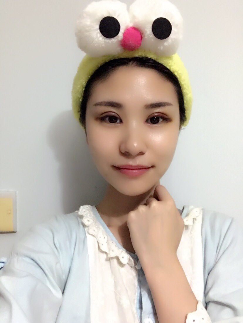 开内眼角第5天