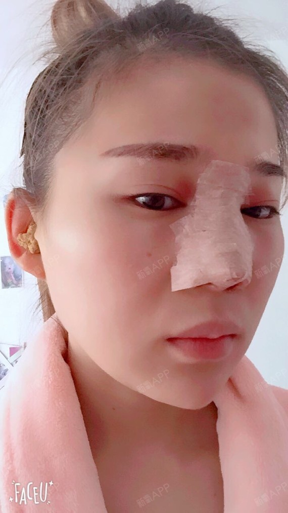 氧气8202771509247328鼻中隔软骨隆鼻第1天