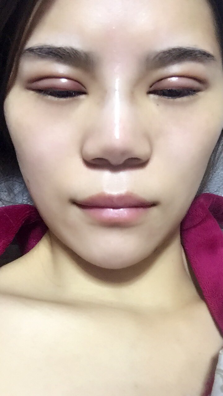 埋线双眼皮第2天