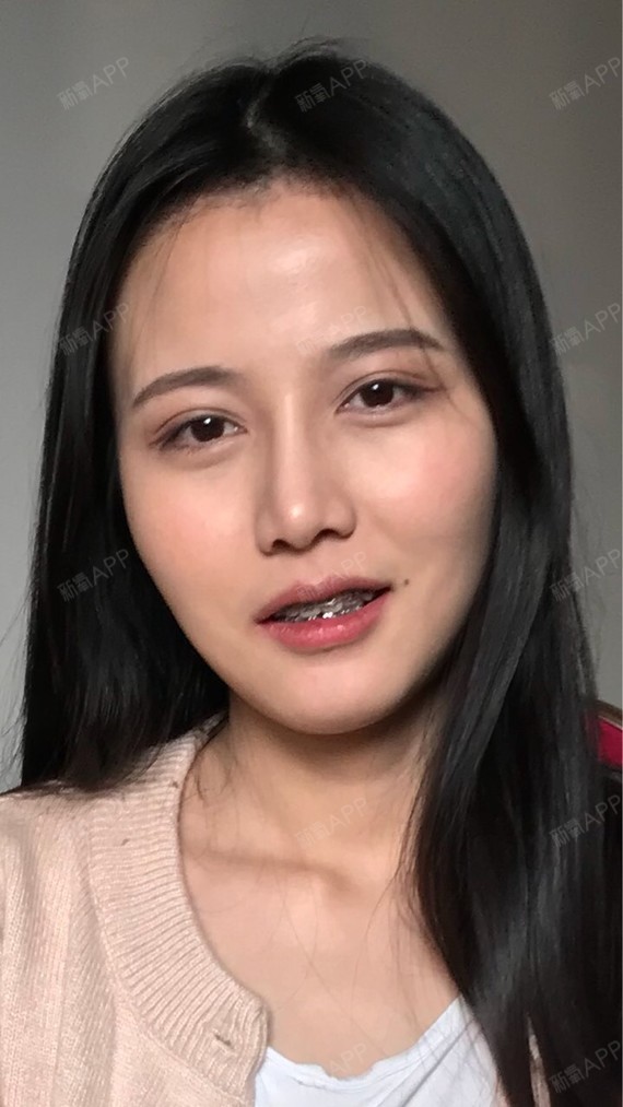 泡泡是条鱼宽鼻矫正第607天美丽日记-新氧美容