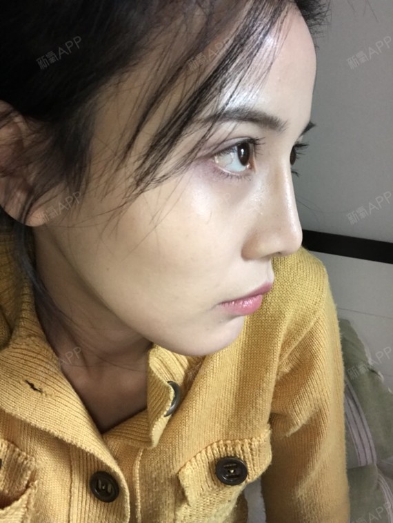 泡泡是条鱼宽鼻矫正第607天美丽日记-新氧美容