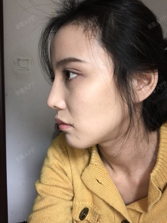 泡泡是条鱼宽鼻矫正第607天美丽日记-新氧美容