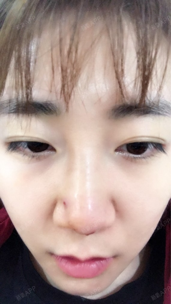 zoeeee埋线隆鼻第0天美丽日记-新氧美容整形