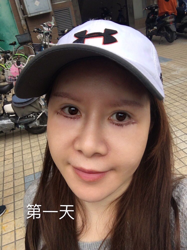 深圳兰乔医疗美容门诊部外切去眼袋怎么样?_gigihello