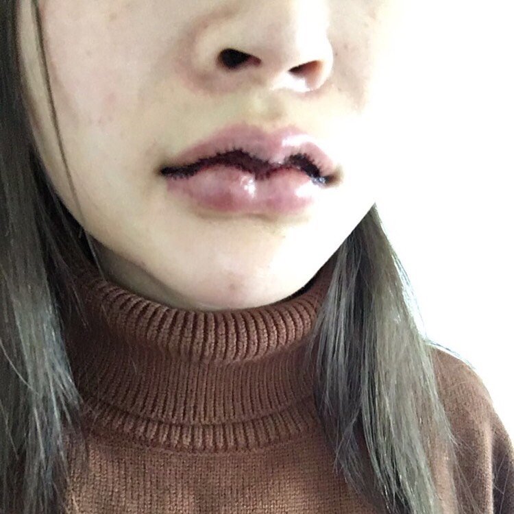 m唇手术第2天