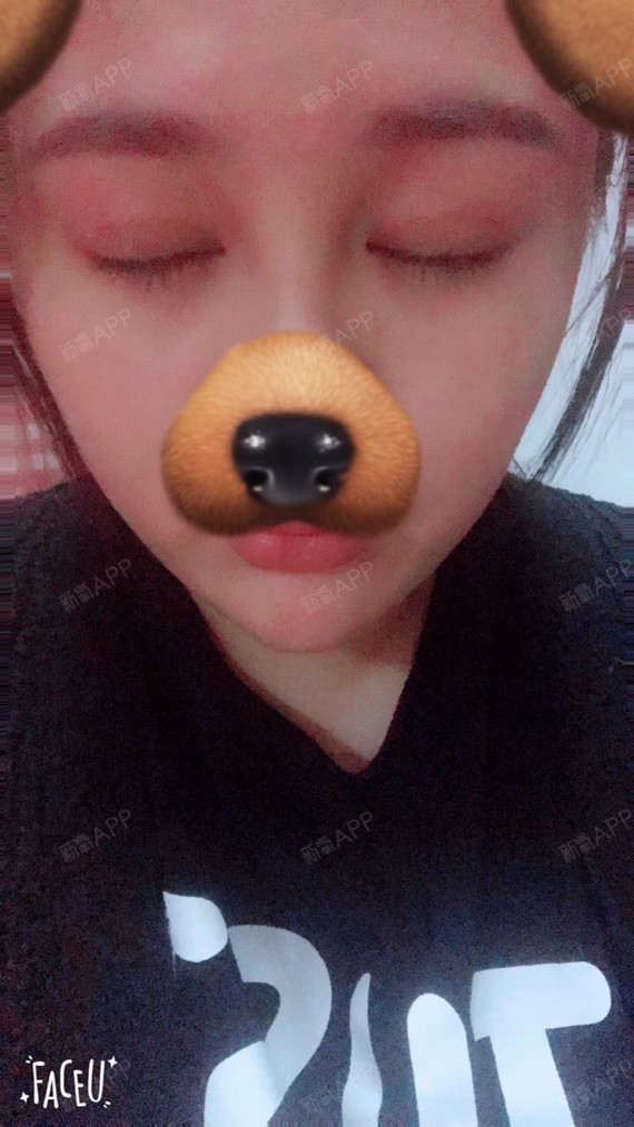 阿娇aa开内眼角第50天美丽日记-新氧美容整形