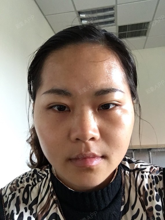 咬肌的地方,我已经不想用咬肌吃饭了,也许是真的萎缩了吧