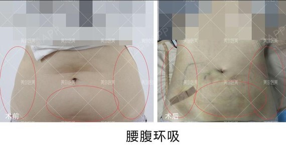 腰腹部环吸术是腰腹部吸脂塑形效果最快且明_圈子