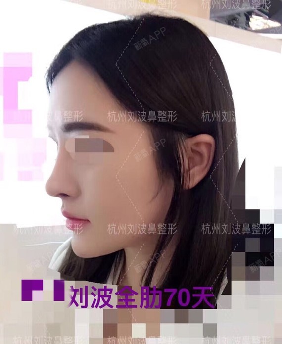 这个案例印象中鼻基底放了许多肋软骨