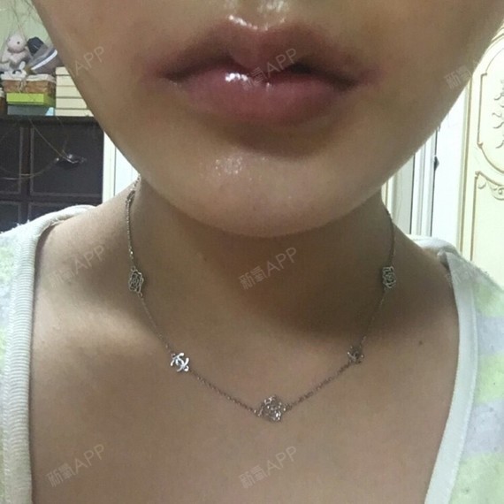 手术项目:嘴角上扬术 m唇手术