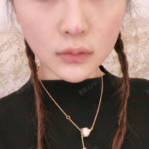 安家小轩m唇手术第3天美丽日记