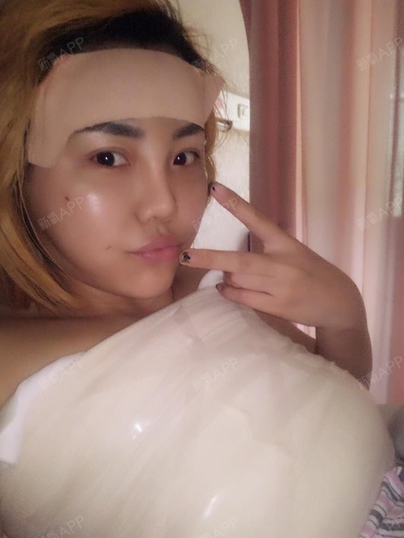 新氧-情趣小公举|情趣脂肪填充全脸|术后当自强|重庆同城酒店查询床v情趣太原自体图片