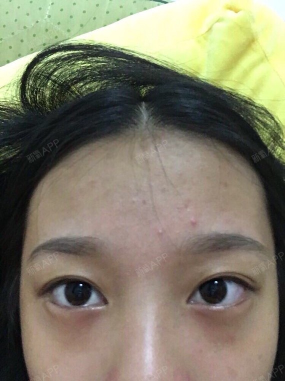 这是用了双眼皮胶水卸了妆后眼睛的效果,早上