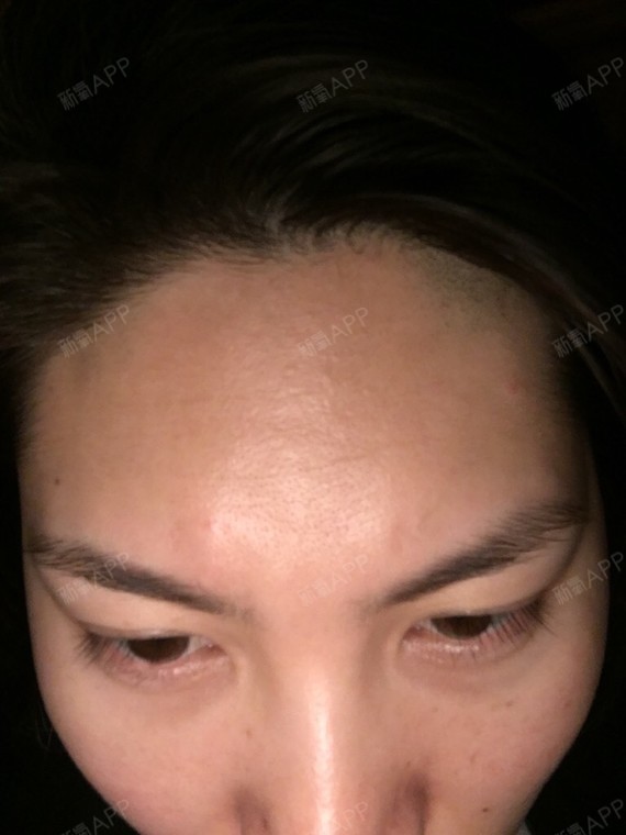 玻尿酸填充额头