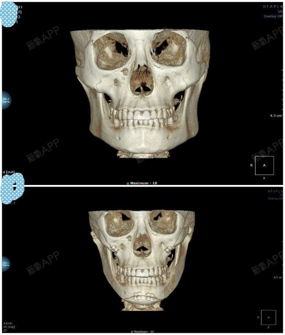 以下是我的ct