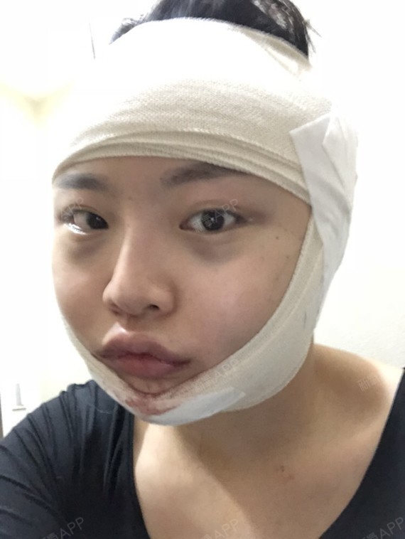 叫我开心脸颧骨颧弓整形术第0天美丽日记-新氧