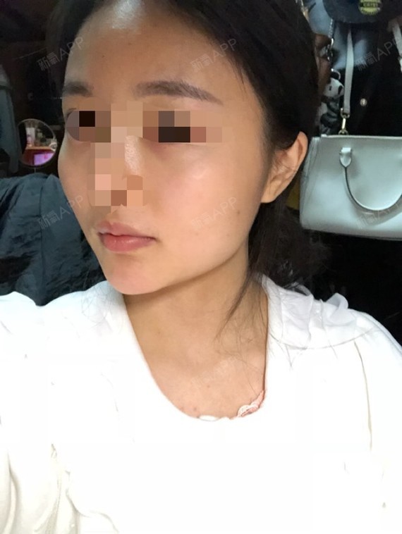 叫我开心脸颧骨颧弓整形术第5天美丽日记-新氧