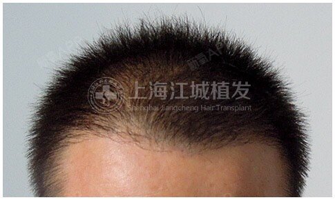 上海江城医疗美容种植发际线第0天美丽日记-新