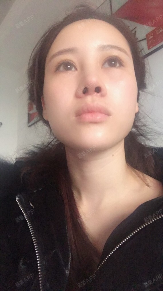 两个星期了  准备三个月后修复,手术前沟通的要秀气的鼻子,鼻翼鼻孔