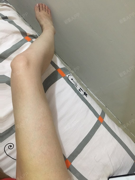 今天开个关于吸脂手术并发及后遗症问题的专题贴.
