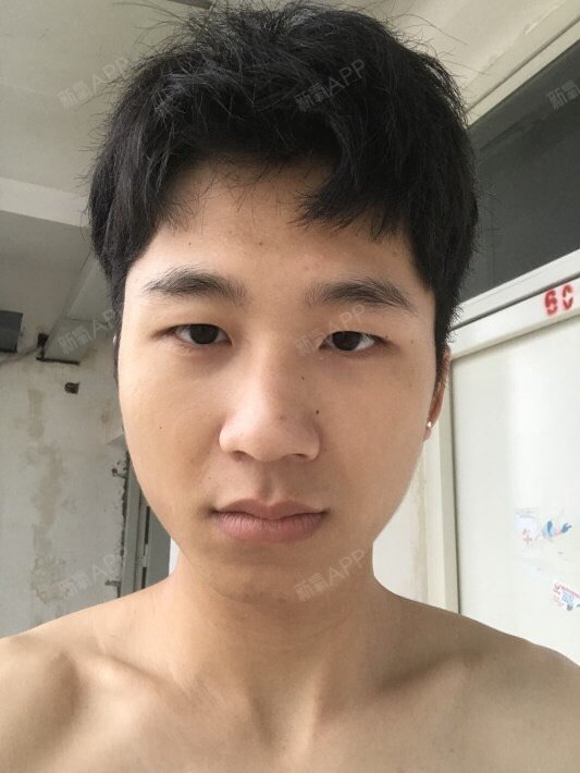 软骨组织隆鼻和假体隆鼻哪种比较好呢?软骨组