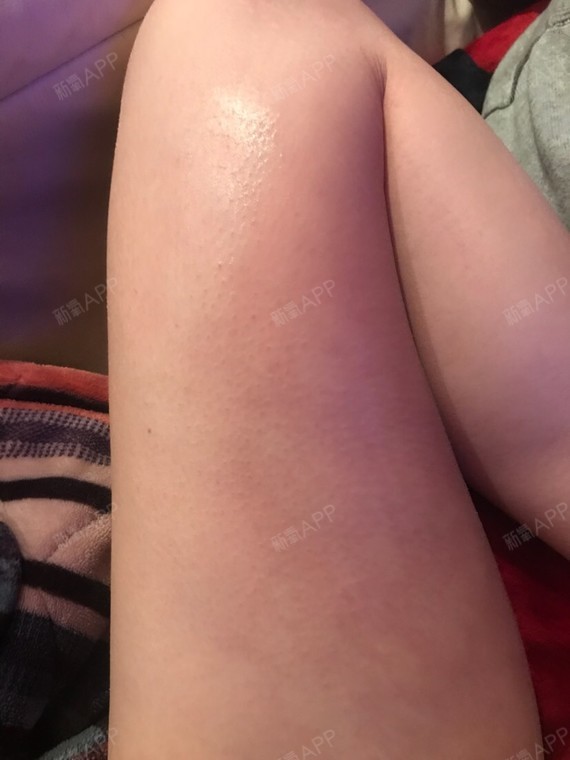 自体脂肪填充后腿凹陷,而且大腿内侧颜色很深 怎么办啊