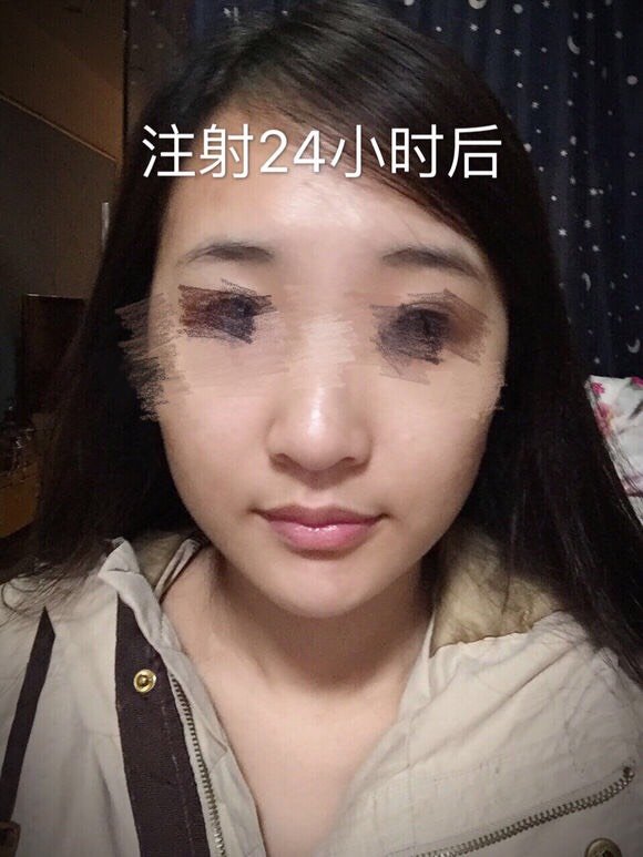 先上几张注射前的样子,我的下巴不短,也不内缩.就是有个缺呀.