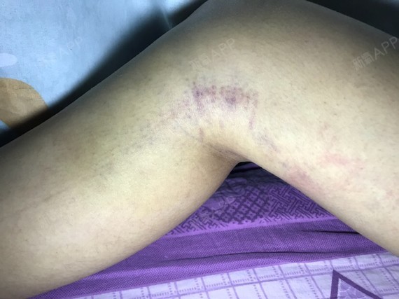 两条腿膝盖内侧淤青比较严重,也是非常疼的部位之一