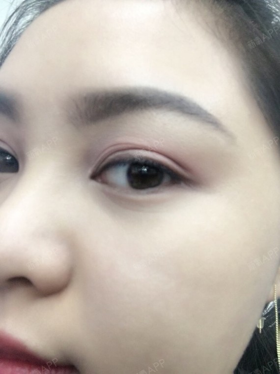 询问医生 医生告诉我美瞳线会有一个反色期  一般一个月左右的时候会