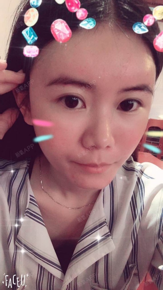 DISAPPEAR逗逗自体脂肪全脸填充第11天美丽